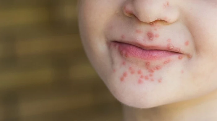Infecțiile cu enterovirus la copii