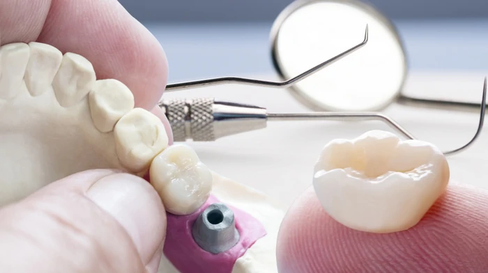 implantare dentară
